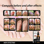 EELHOE Fungal Nail Treatment Oil – Extra Strong Nail Repair Care, 30ml