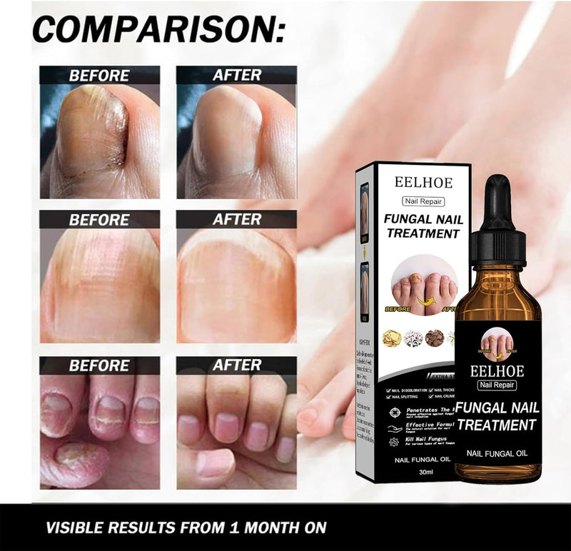 EELHOE Fungal Nail Treatment Oil – Extra Strong Nail Repair Care, 30ml